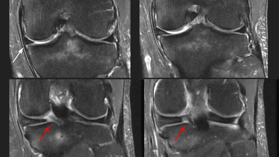 Figure 1 for case posterior horn of medial meniscus ( RID2776 )